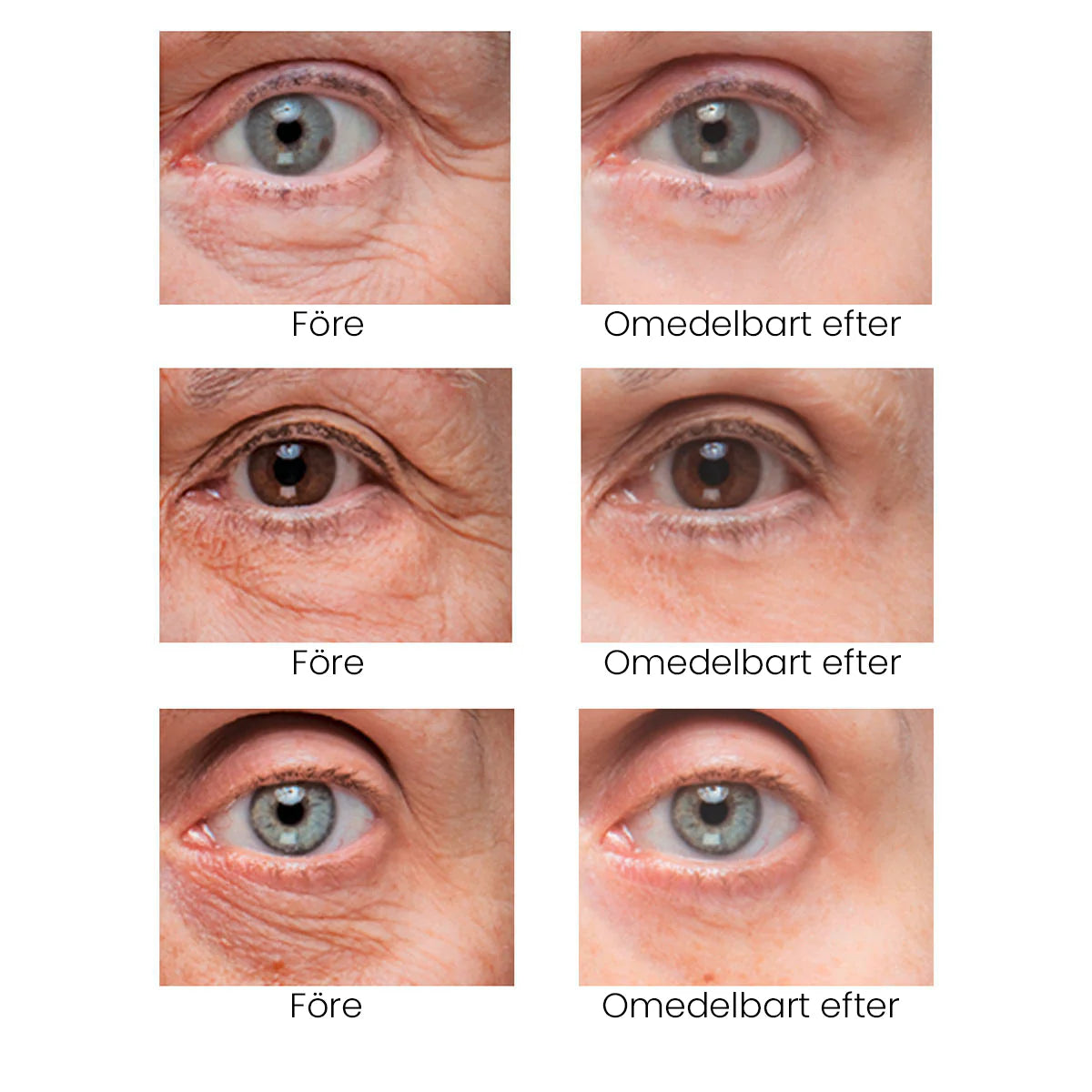 EYERISE - Slätare runt ögonen utan injektioner!