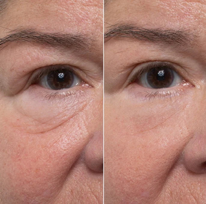 EYERISE - Slätare runt ögonen utan injektioner!